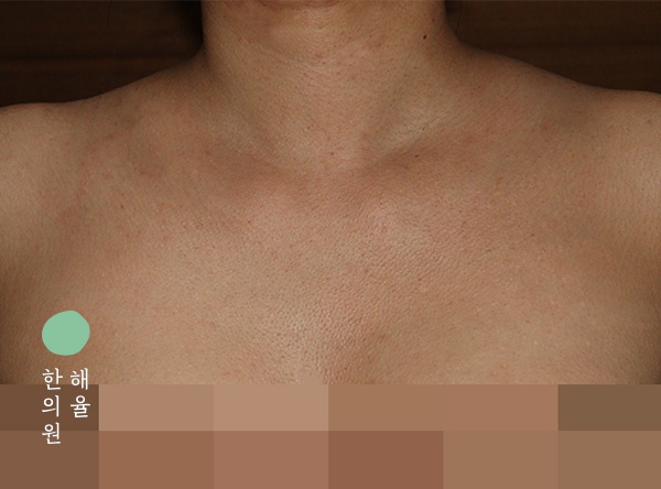 [울산점] 가드름 치료, 가슴 여드름 자국까지 신경 쓰인다면 울산 해율한의원 치료 방법은 - 해율한의원