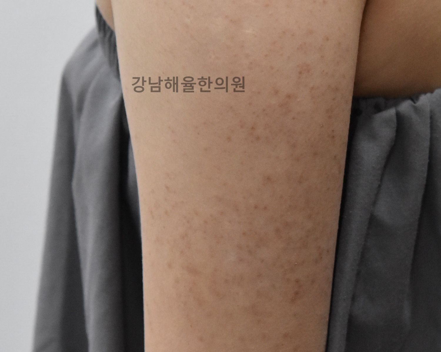[강남점] 강남모공각화증 얼굴에도 생길 수 있나요? - 해율한의원