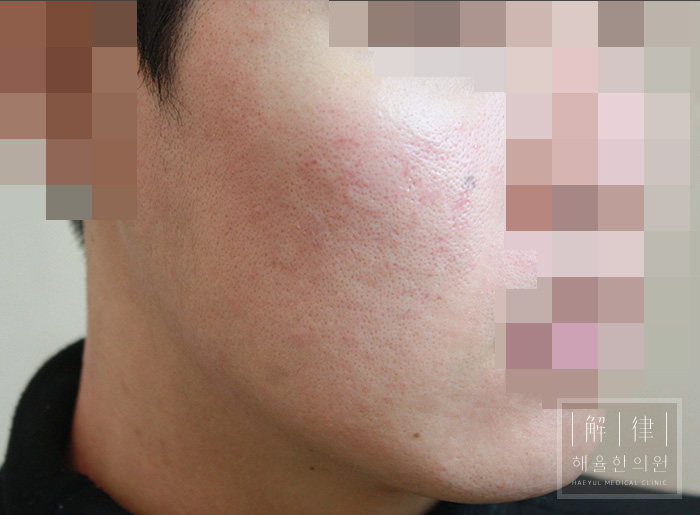 [광주점] 광주여드름피부과 한의원 치료에서 한약은 어떻게 활용되나요? - 해율한의원