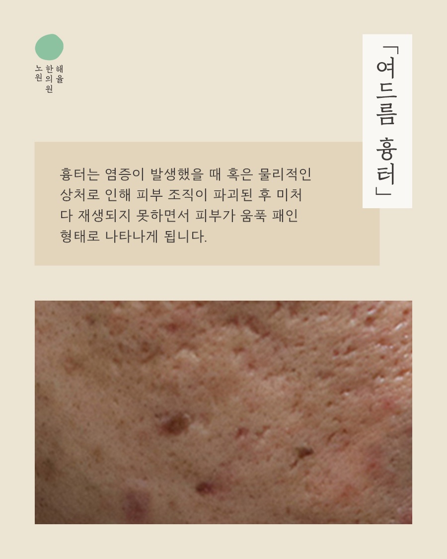 [노원점] 노원여드름흉터 치료 시기를 고민하고 있다면? - 해율한의원