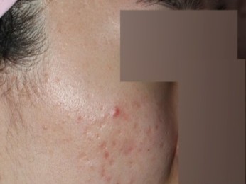 [대구점] 대구새살침 부작용이나 주의사항이 있나요? - 해율한의원