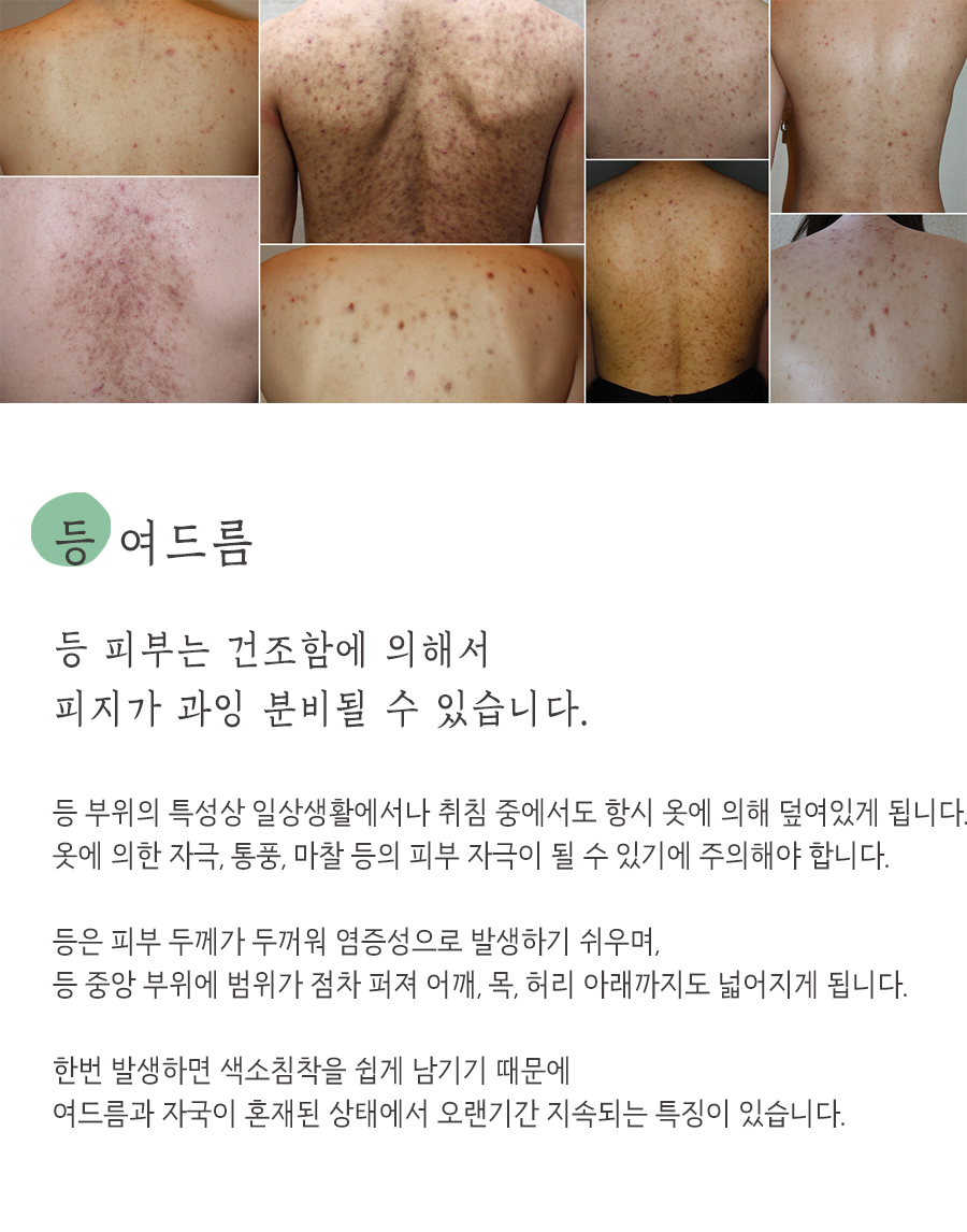 [수원점] 수원가슴여드름 관리할 때 흔히 하는 실수는? - 해율한의원