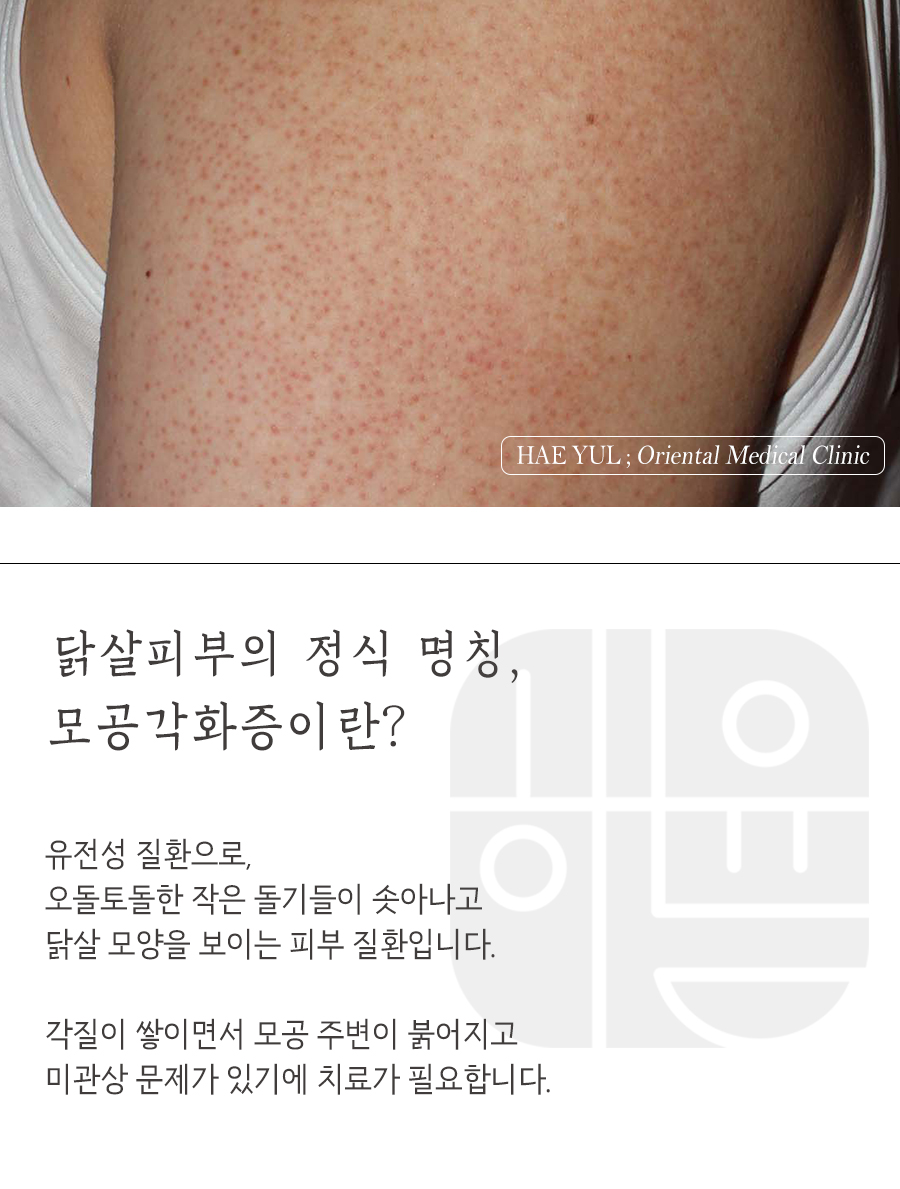 [강남점] 강남모공각화증 얼굴에도 생길 수 있나요? - 해율한의원
