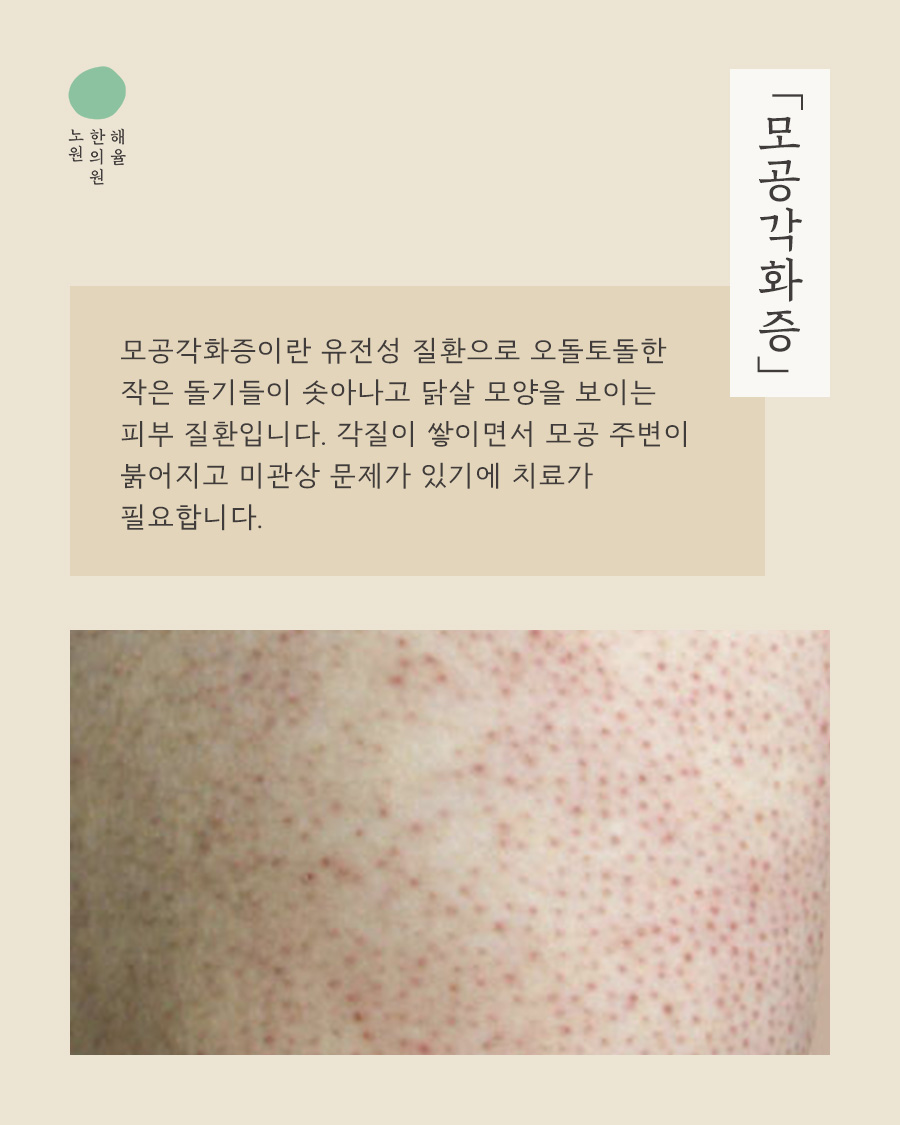 [노원점] 노원모공각화증 닭살과 구분하는 방법 원장님이 설명드립니다 - 해율한의원