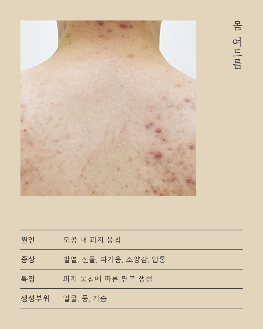[노원점] 노원모공각화증 닭살과 구분하는 방법 원장님이 설명드립니다 - 해율한의원