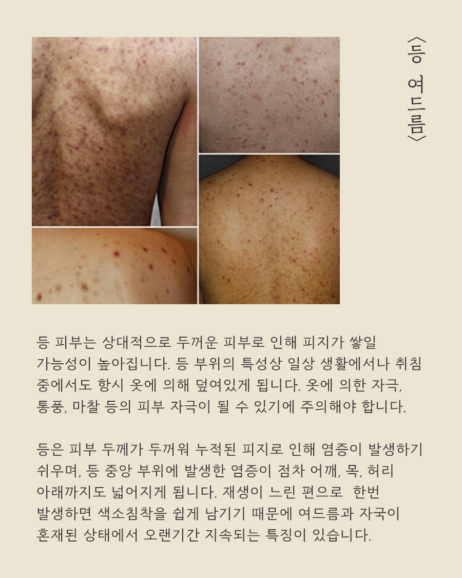 [목동점] 목동가슴여드름 모낭염과 어떻게 다른가요? 원장님이 설명드립니다 - 해율한의원