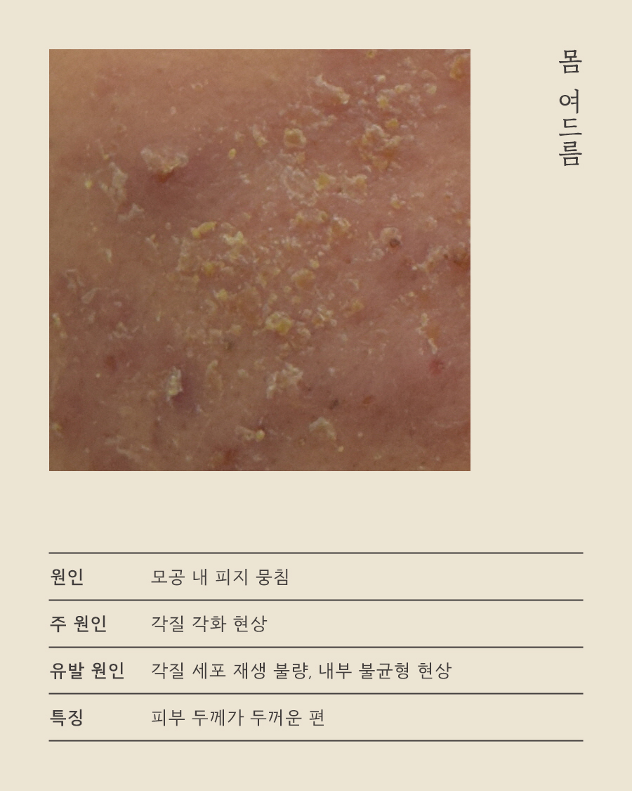 [목동점] 목동가슴여드름 모낭염과 어떻게 다른가요? 원장님이 설명드립니다 - 해율한의원
