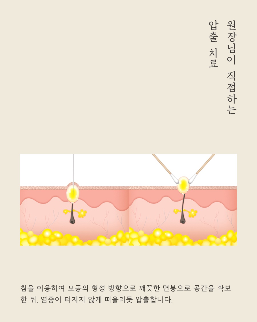 [분당점] 분당새살침, 여드름 흉터는 왜 쉽게 없어지지 않을까? - 해율한의원