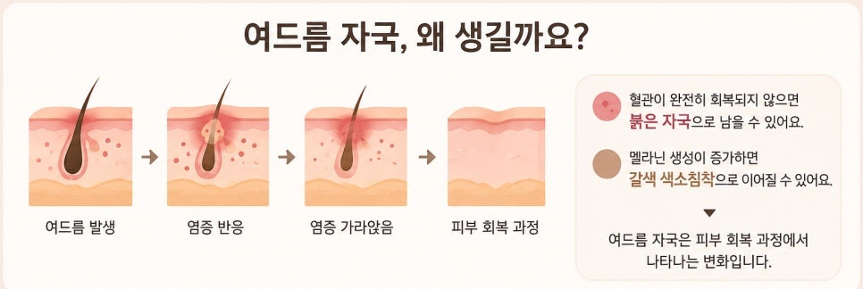 [분당점] 분당여드름자국 색소자국이 오래 남는 이유는? - 해율한의원