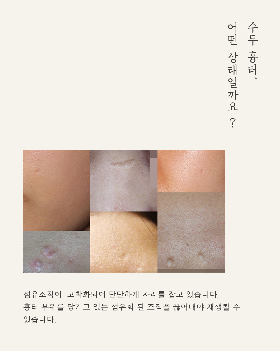 [대구점] 대구패인흉터 수두흉터 자연적으로 없어지지 않는 이유는? - 해율한의원