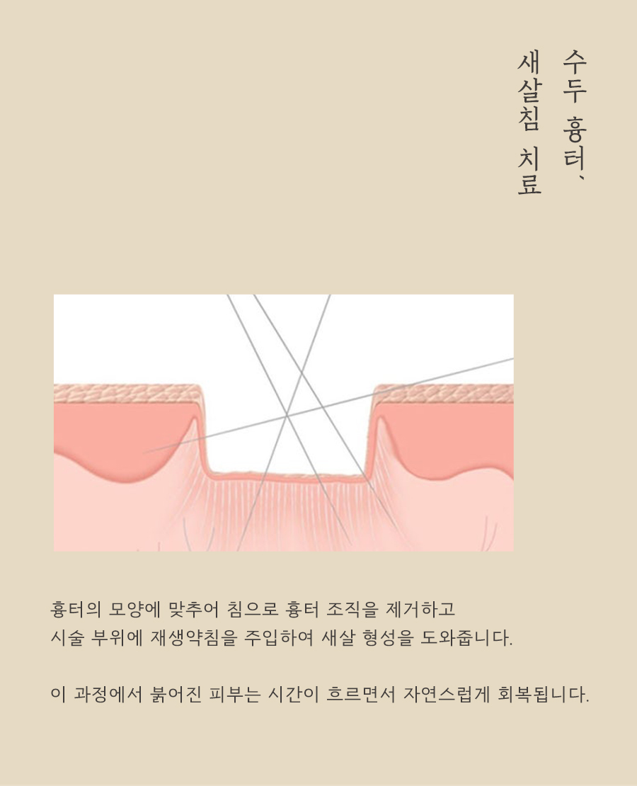 [천안점] 천안패인흉터 수두흉터 치료 방법에 대해 알려드려요 - 해율한의원