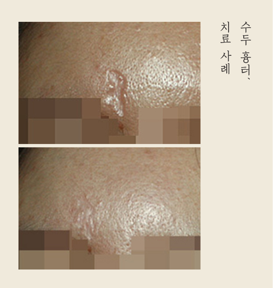 [대구점] 대구패인흉터 수두흉터 자연적으로 없어지지 않는 이유는? - 해율한의원
