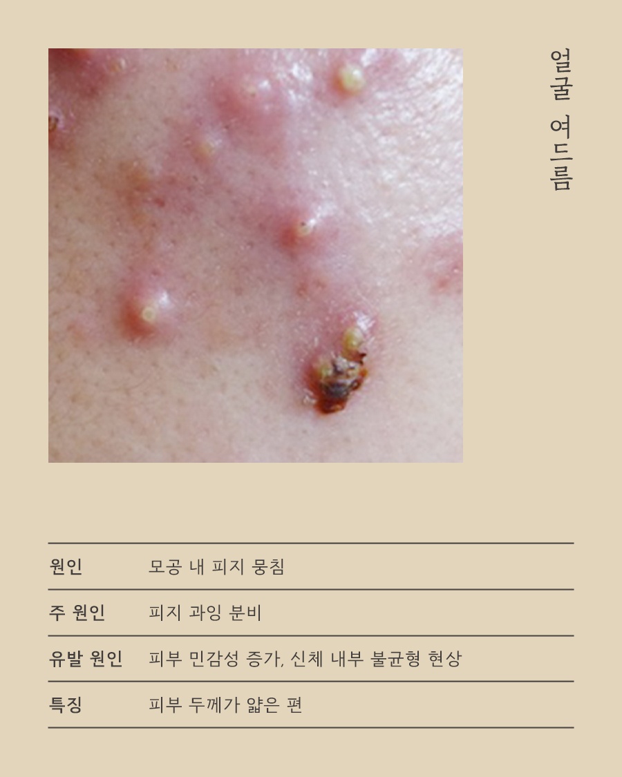 [수원점] 수원등여드름 어느 순간 넓게 번지고 있다면 원인 설명드립니다 - 해율한의원