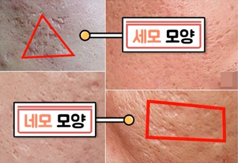 [수원점] 수원여드름흉터 압출 후 생겼다면? 새살침으로 치료하는 방법 - 해율한의원