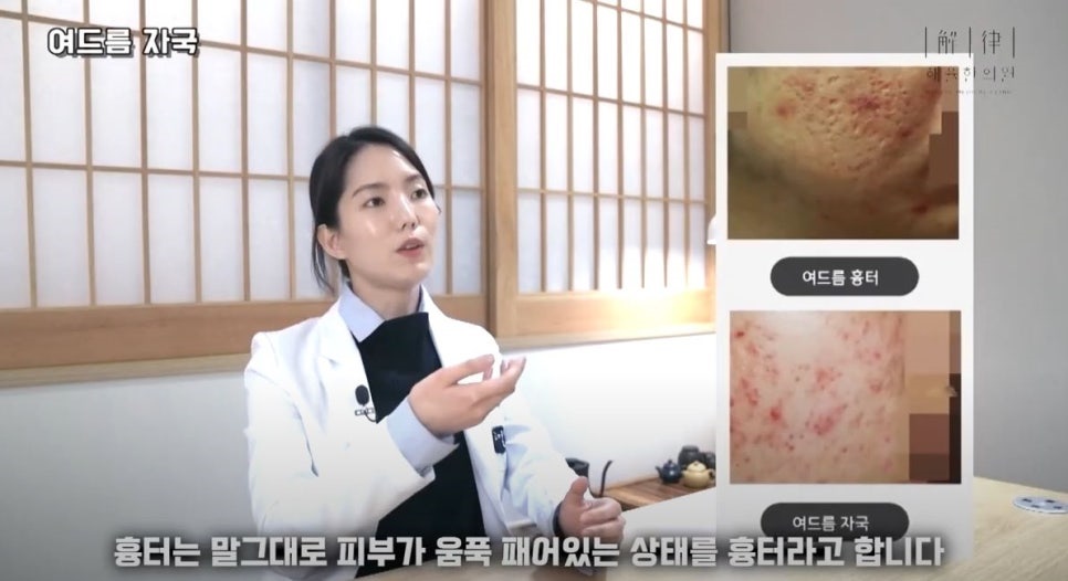[수원점] 수원여드름흉터 압출 후 생겼다면? 새살침으로 치료하는 방법 - 해율한의원