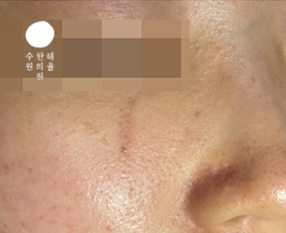 [수원점] 20년 이상 오래된 흉터도 새살침으로 채울 수 있나요? - 해율한의원