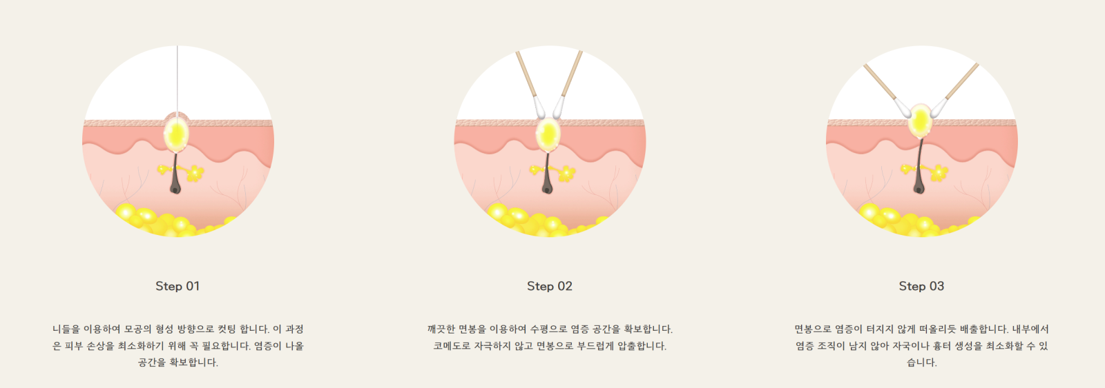 [수원점] 여드름은 왜 생길까요? - 해율한의원