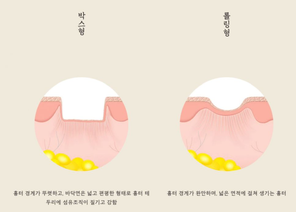 [수원점] 여드름흉터치료 무조건 빨리 시작할수록 좋은가요? - 해율한의원