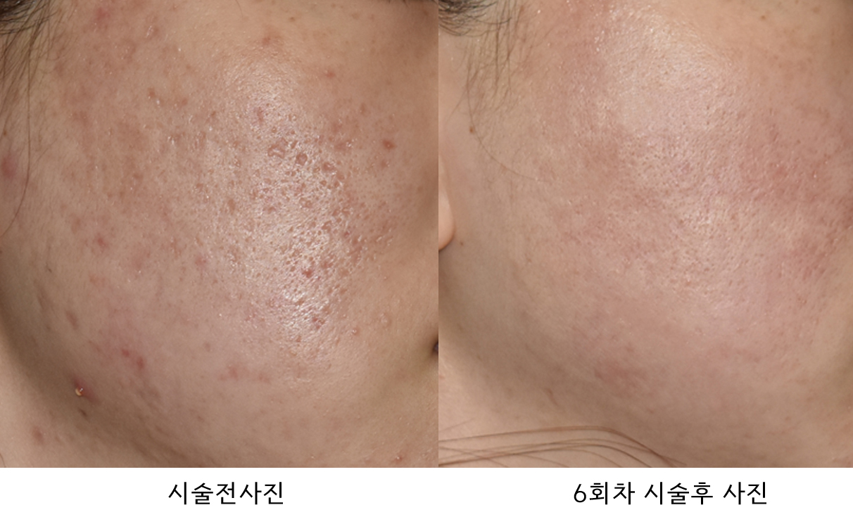 [울산점] [울산 해율한의원] 박스카 형태의 여드름 흉터 치료 케이스 - 해율한의원