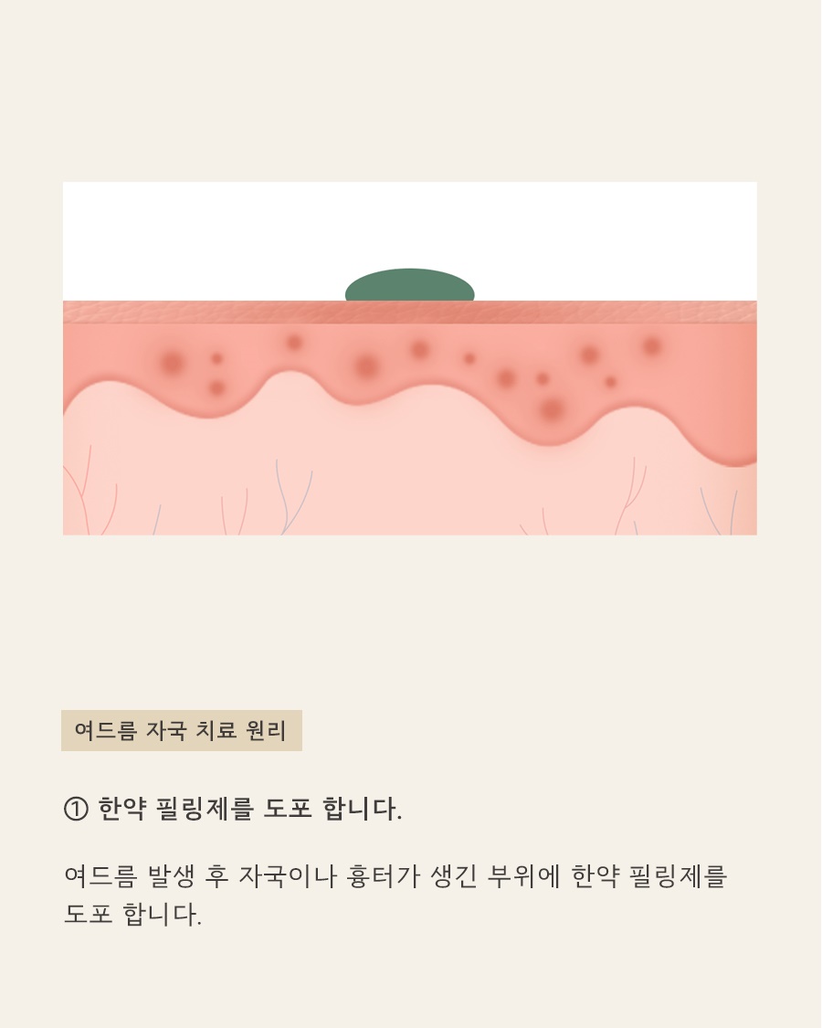 [안산점] 안산여드름자국 흉터랑 다른가요? 구분 및 예방법 - 해율한의원