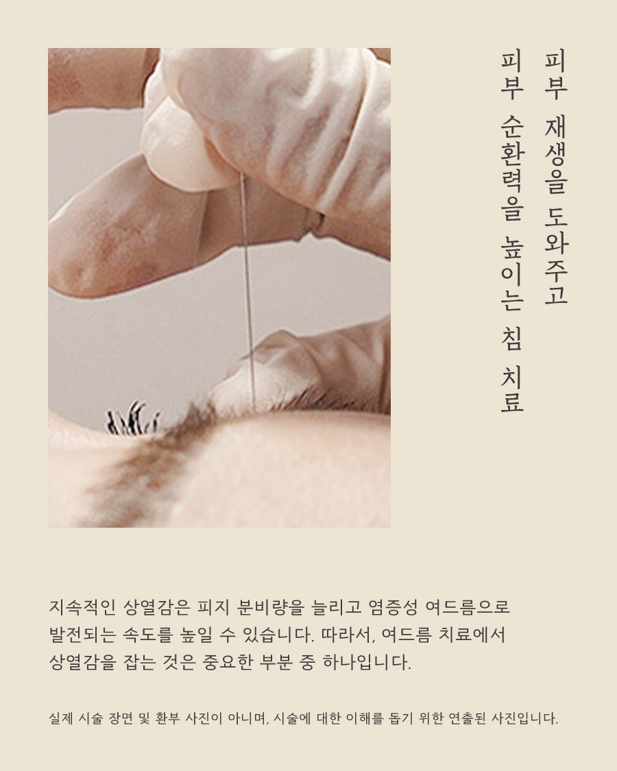[안산점] 안산여드름피부과 한의원 갑자기 여드름이 늘었다면? - 해율한의원