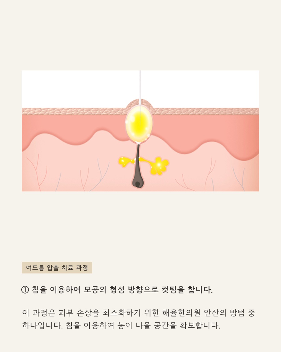 [안산점] 안산여드름피부과 한의원 갑자기 여드름이 늘었다면? - 해율한의원