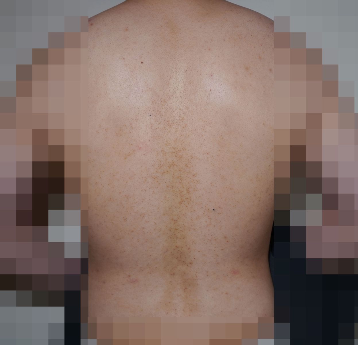 [안양점] 안양모공각화증 자꾸 만져지는 오돌토돌한 피부 고민, 원장님이 설명드립니다 - 해율한의원