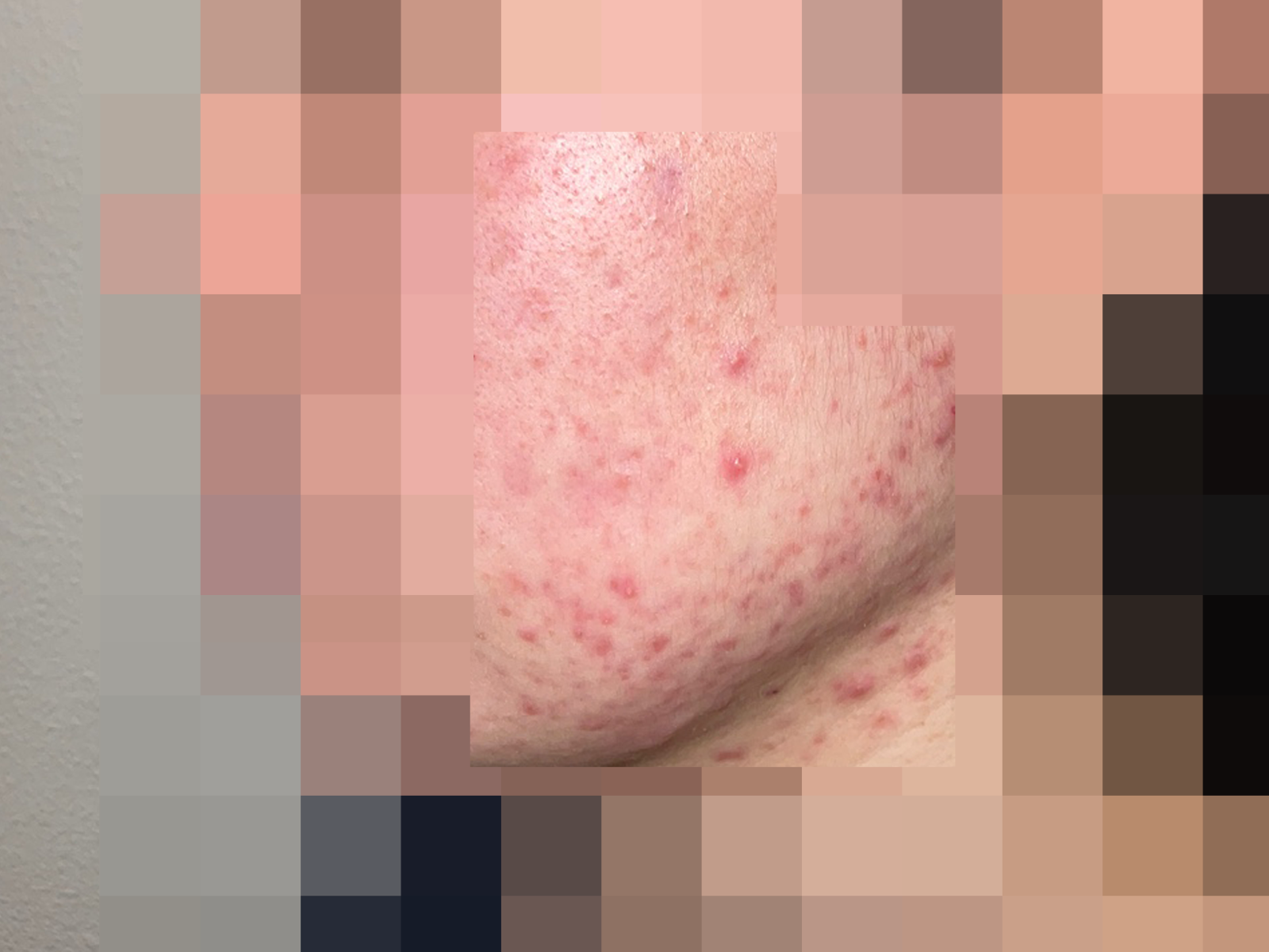 [안양점] 안양여드름한의원 피부 상태에 따라 치료 방법이 달라지나요? - 해율한의원