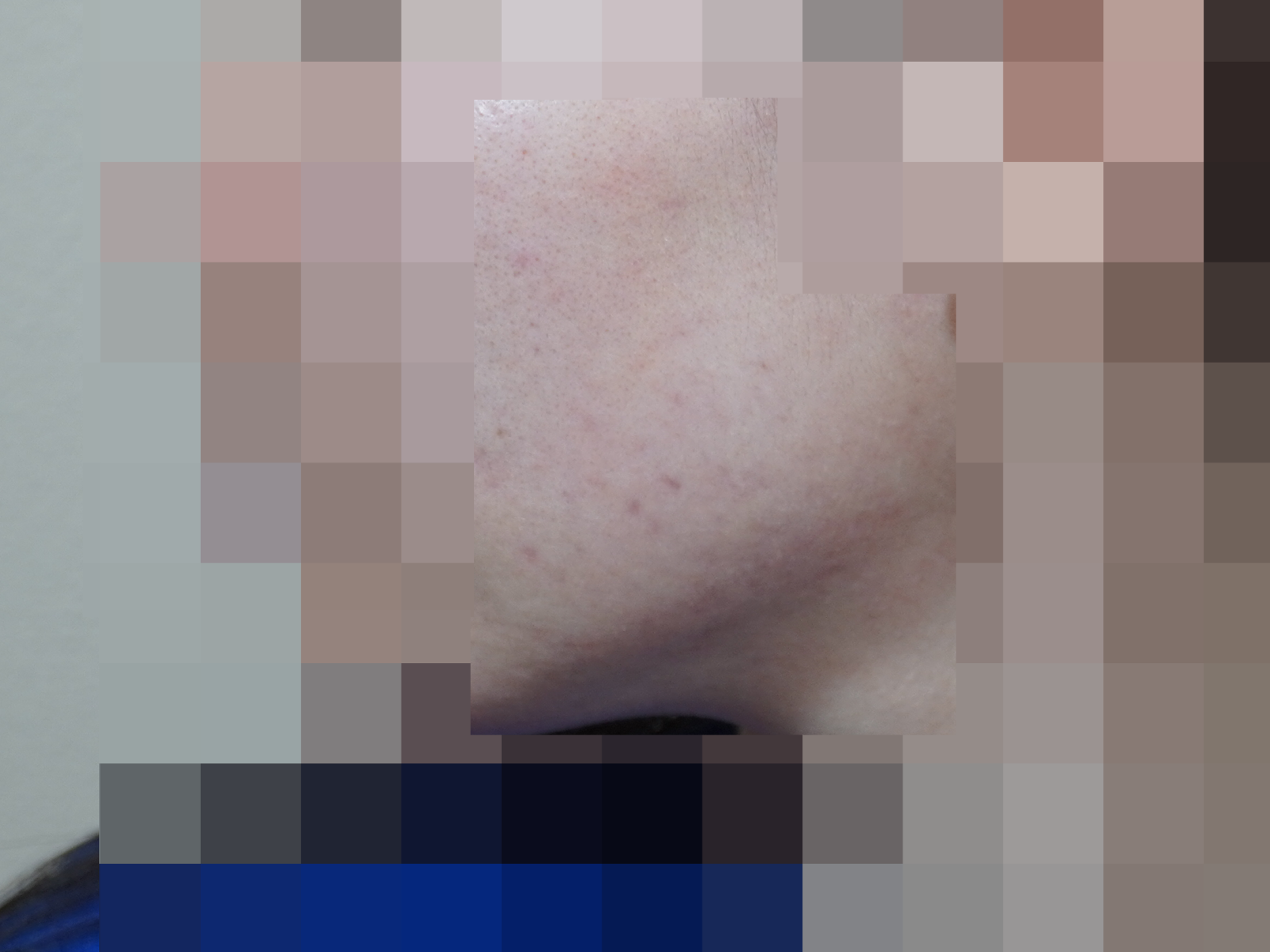 [안양점] 안양여드름한의원 피부 상태에 따라 치료 방법이 달라지나요? - 해율한의원