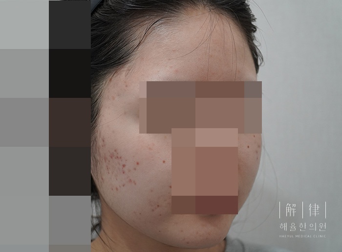 [안산점] 여드름 색소침착 피부에 남는 이유와 관리하는 방법 안산 해율한의원에서 알려드려요 - 해율한의원