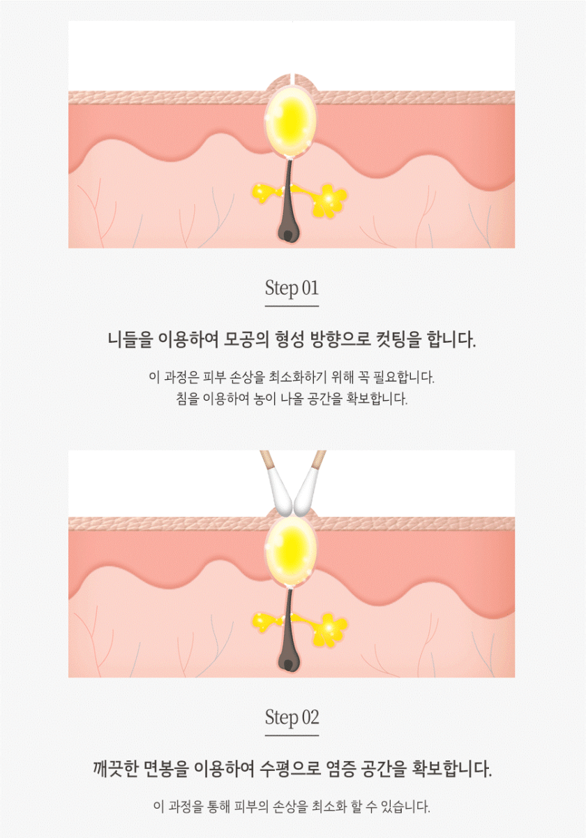 [창원점] 창원여드름치료 압출 꼭 해야 하나요? 원장님이 설명드립니다 - 해율한의원
