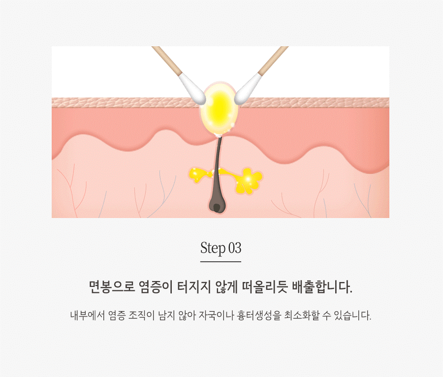 [창원점] 창원여드름치료 압출 꼭 해야 하나요? 원장님이 설명드립니다 - 해율한의원