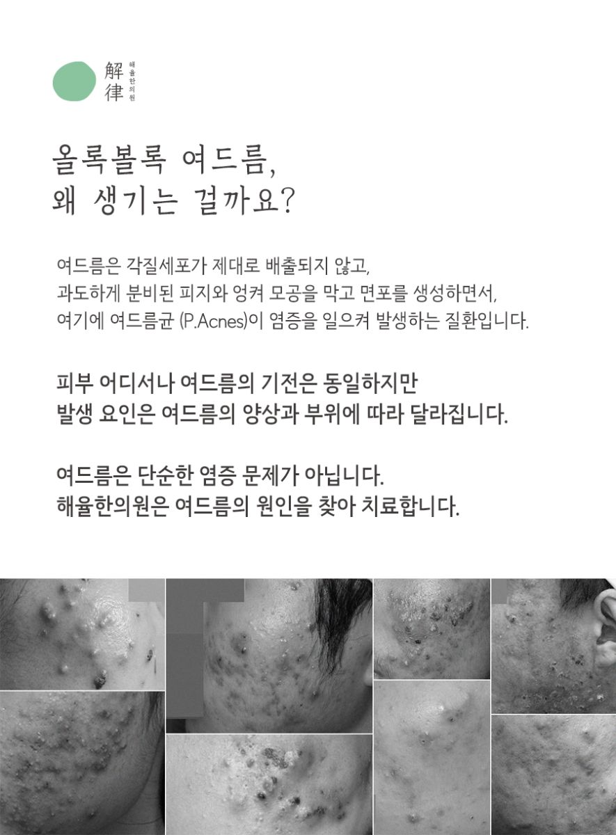 [분당점] 여드름치료 미루면 안되는 이유 분당해율한의원에서 알려드려요 - 해율한의원