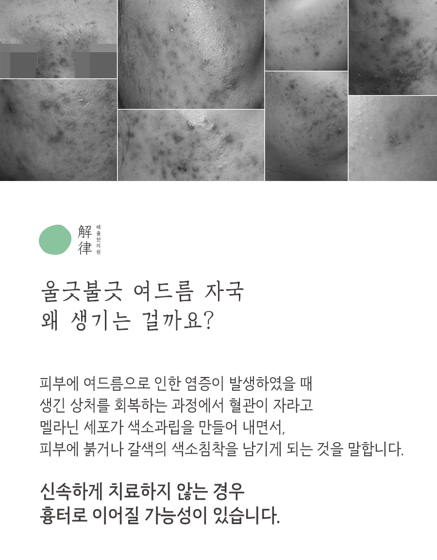 [수원점] 수원여드름자국 미세약초침 치료 후 주의해야 하는 부분은? - 해율한의원