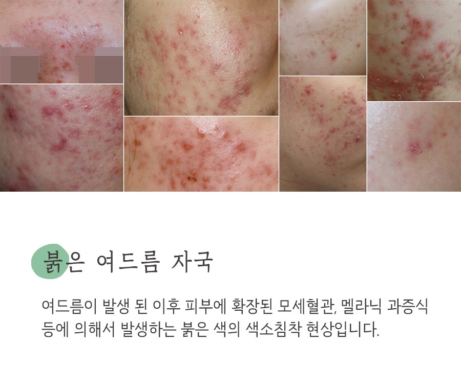 [안산점] 안산여드름자국 오래 남는 이유와 관리법, 원장님이 설명드립니다 - 해율한의원
