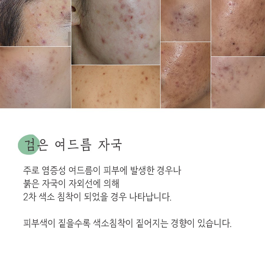 [안산점] 안산여드름자국 오래 남는 이유와 관리법, 원장님이 설명드립니다 - 해율한의원