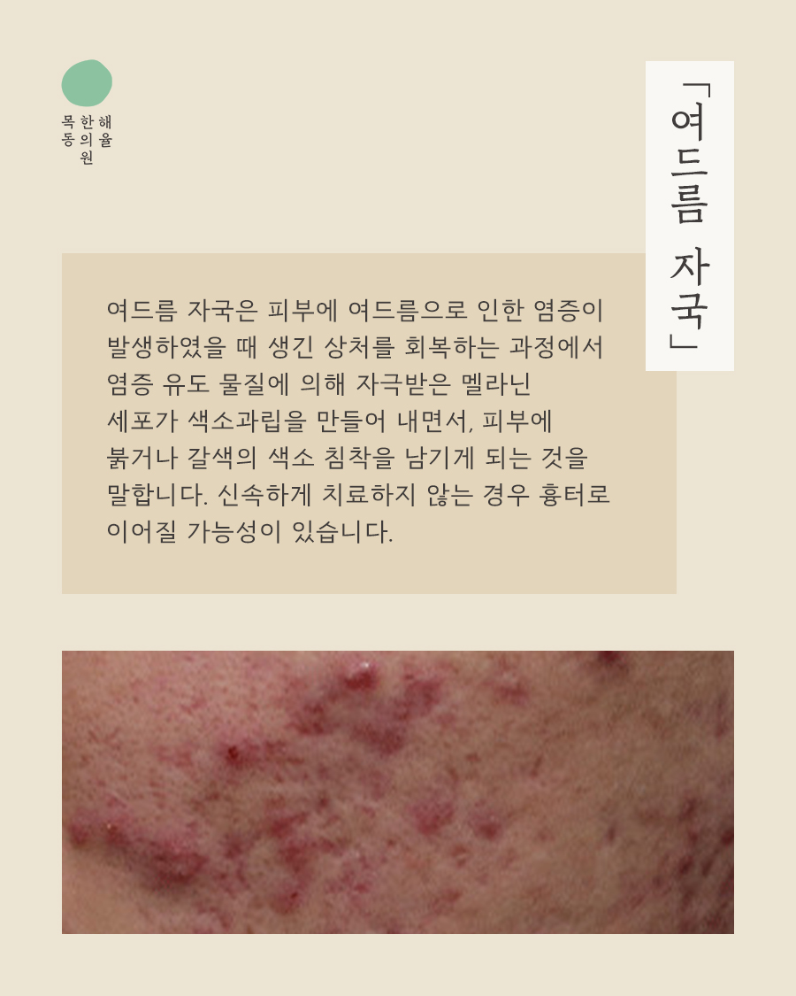 [목동점] 목동여드름자국 쉽게 옅어지지 않는 이유는? - 해율한의원