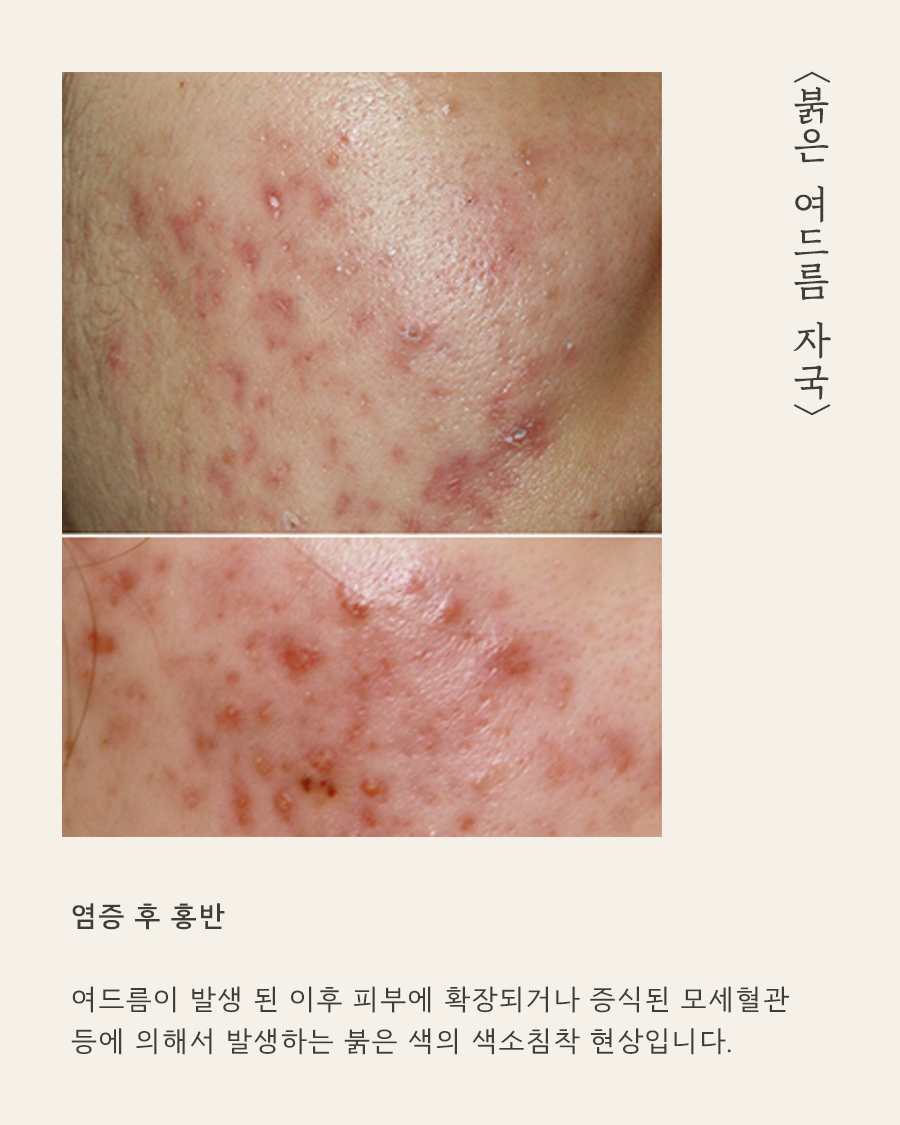 [목동점] 목동여드름자국 쉽게 옅어지지 않는 이유는? - 해율한의원