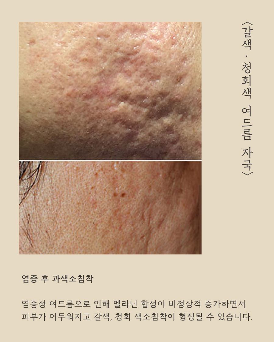 [목동점] 목동여드름자국 쉽게 옅어지지 않는 이유는? - 해율한의원