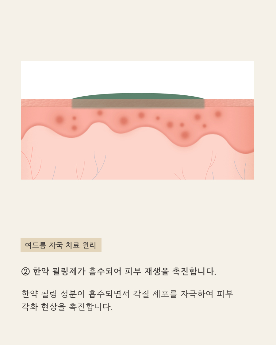 [목동점] 목동여드름자국 쉽게 옅어지지 않는 이유는? - 해율한의원