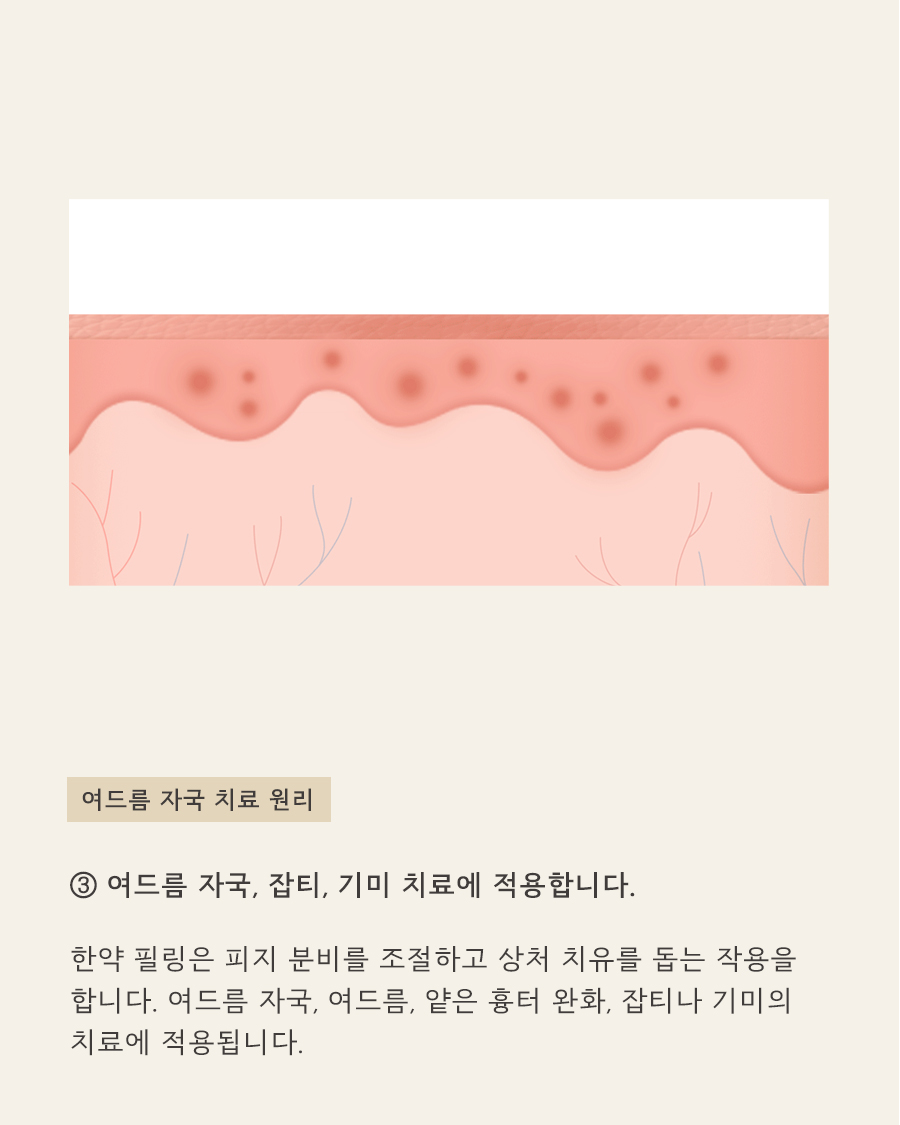 [목동점] 목동여드름자국 쉽게 옅어지지 않는 이유는? - 해율한의원