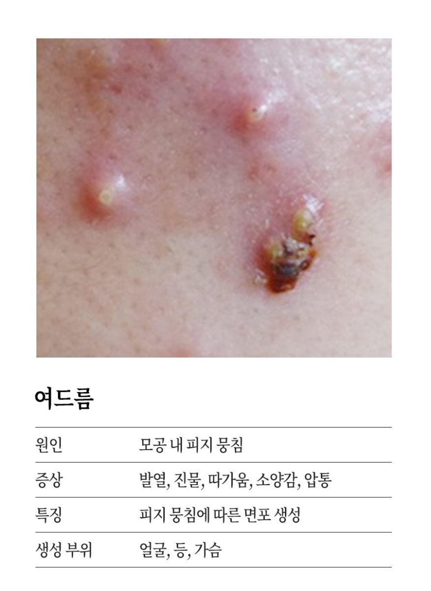 [분당점] 지루성피부염 붉고 가려운 이유, 치료까지 분당 해율한의원이 설명드립니다 - 해율한의원