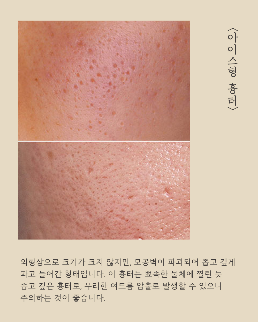 [노원점] 노원여드름흉터 새살침 치료 과정은? - 해율한의원