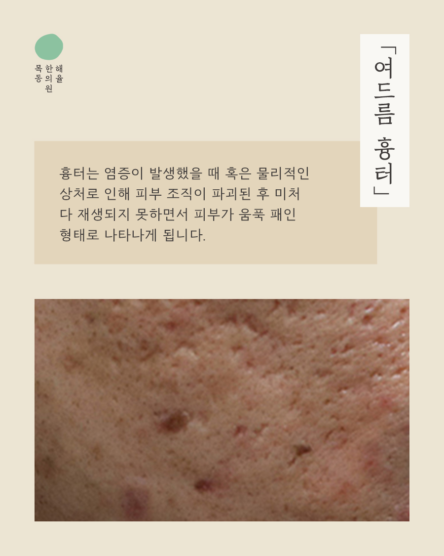 [목동점] 화장으로 가려지지 않는 여드름흉터, 어떻게 치료할까요? - 해율한의원