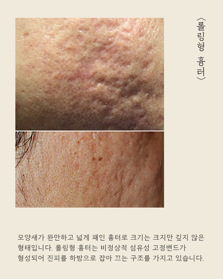 [목동점] 목동여드름 흉터 왜 생길까요? - 해율한의원