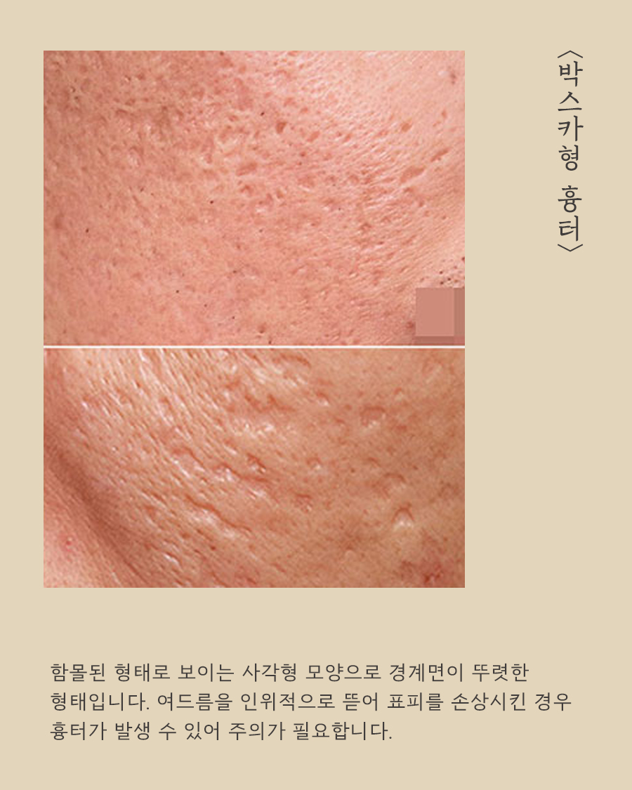 [목동점] 목동여드름 흉터 왜 생길까요? - 해율한의원