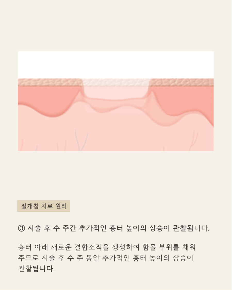 [목동점] 목동여드름 흉터 왜 생길까요? - 해율한의원