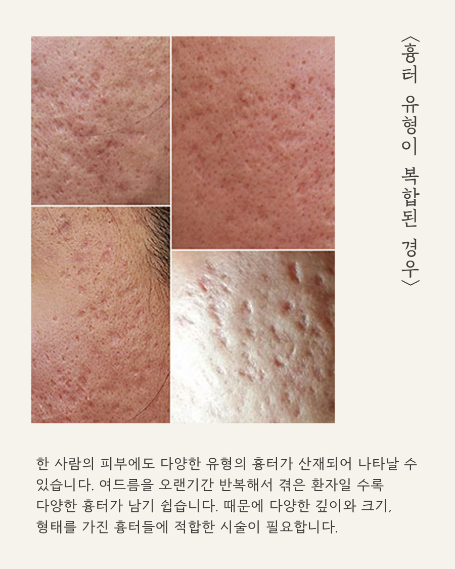 [안양점] 안양새살침 오래된 여드름 흉터도 치료 가능할까요? - 해율한의원