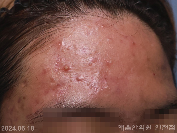 [인천점] 인천피부한의원 여드름 무조건 짜면 안되는 이유, 원장님이 설명드립니다 - 해율한의원