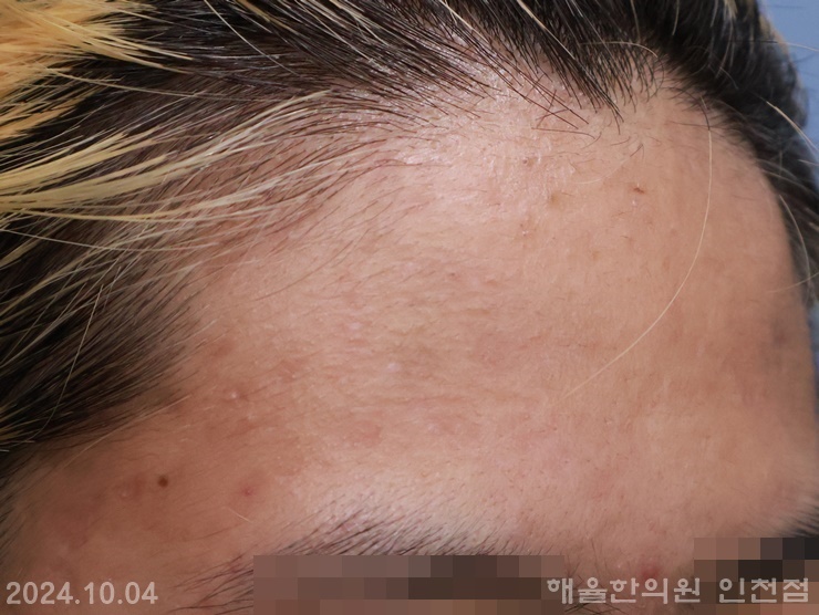 [인천점] 인천피부한의원 여드름 무조건 짜면 안되는 이유, 원장님이 설명드립니다 - 해율한의원